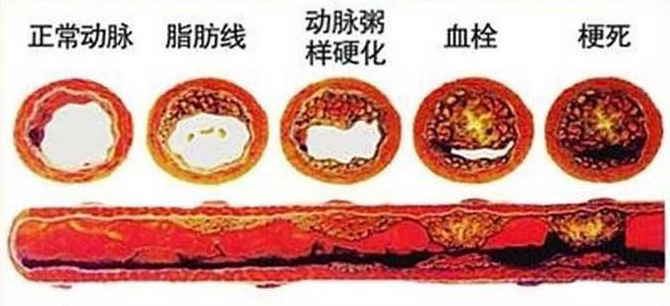 血栓在哪，病就在哪！該怎么清除血栓呢？