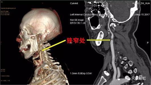 頸椎病都是“積”出來的，4個傷頸的行為，別總是做